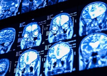 Revelan que un caso grave de covid-19 envejece el cerebro 20 años