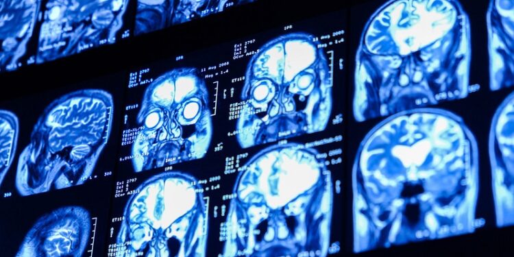 Revelan que un caso grave de covid-19 envejece el cerebro 20 años