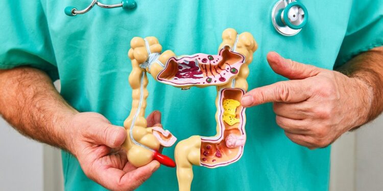 Este el posible ‘culpable’ del alarmante aumento de cáncer de colon en jóvenes