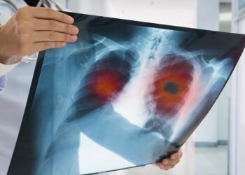 Descubren que la comida chatarra puede elevar el riesgo de sufrir este tipo de cáncer