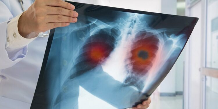 Descubren que la comida chatarra puede elevar el riesgo de sufrir este tipo de cáncer