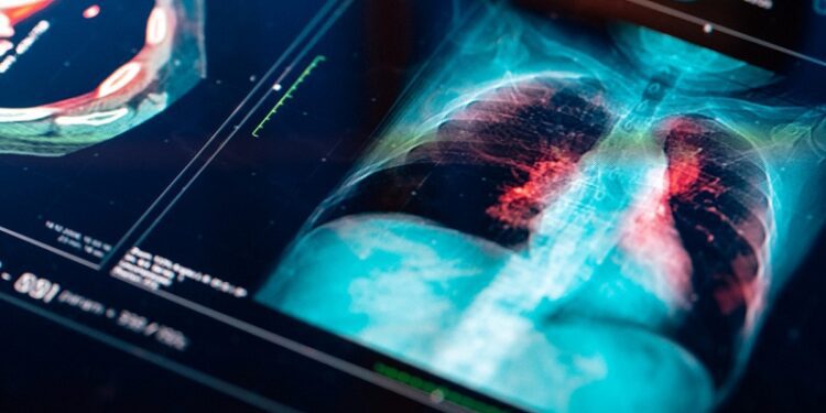 Estas 2 dolencias pueden activar células cancerosas ‘dormidas’ en los pulmones