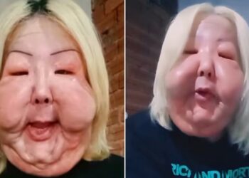 El procedimiento clandestino que desfiguró la cara de una ‘influencer’ brasileña