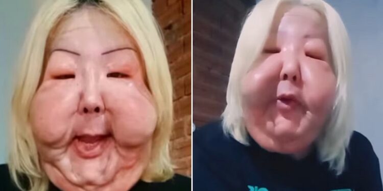 El procedimiento clandestino que desfiguró la cara de una ‘influencer’ brasileña