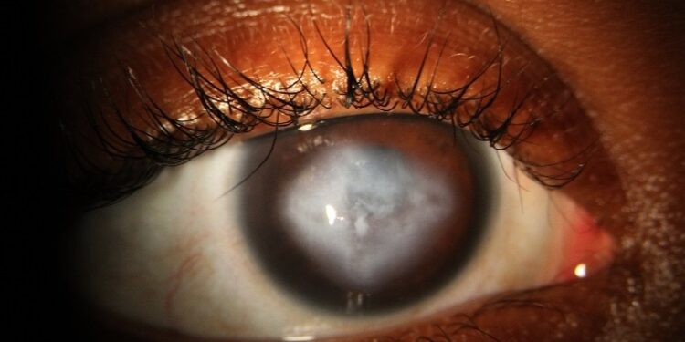 200 mil dominicanos podrían padecer queratocono