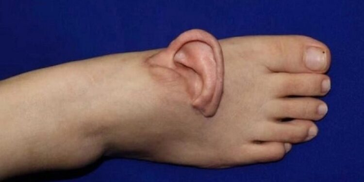 Milagro médico: mujer china llevó su oreja en el pie por 5 meses antes de ser reimplantada