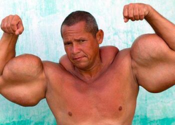 Muere el ‘Popeye brasileño’, conocido por inyectarse aceite mineral en los brazos