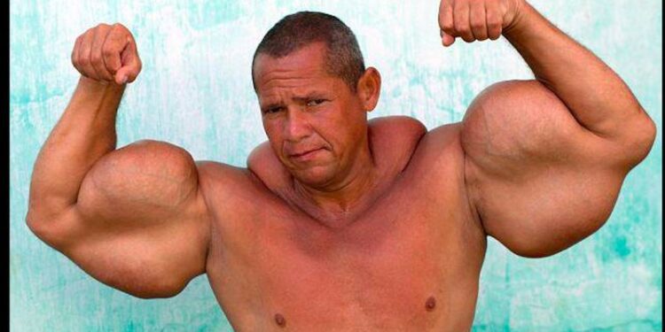 Muere el ‘Popeye brasileño’, conocido por inyectarse aceite mineral en los brazos