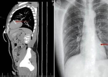Acude al hospital por un dolor al orinar y los médicos encuentran algo inquietante en su cuerpo